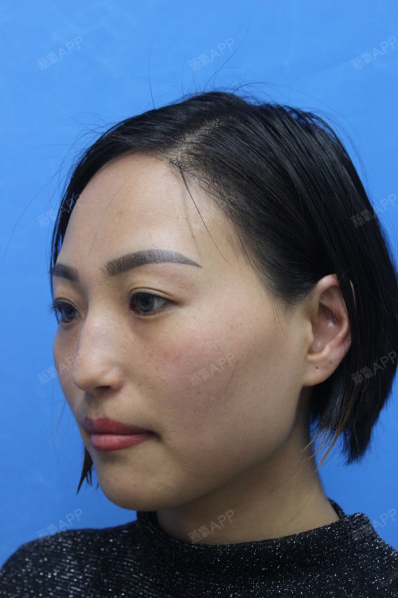 谢冰冰冰鼻综合第0天美丽日记-新氧美容整形