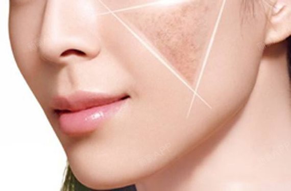 ACMETEA光子嫩肤和激光祛斑的区别?哪个更