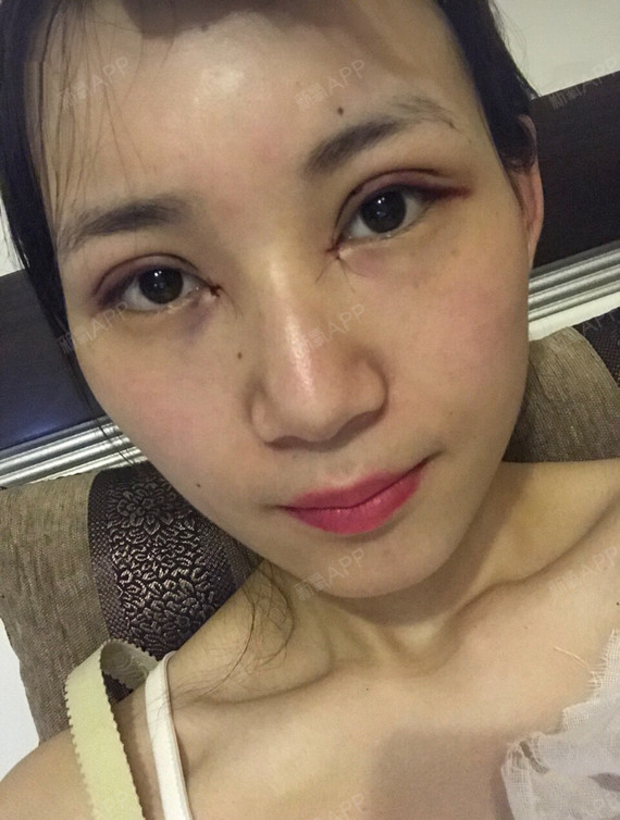 开内眼角