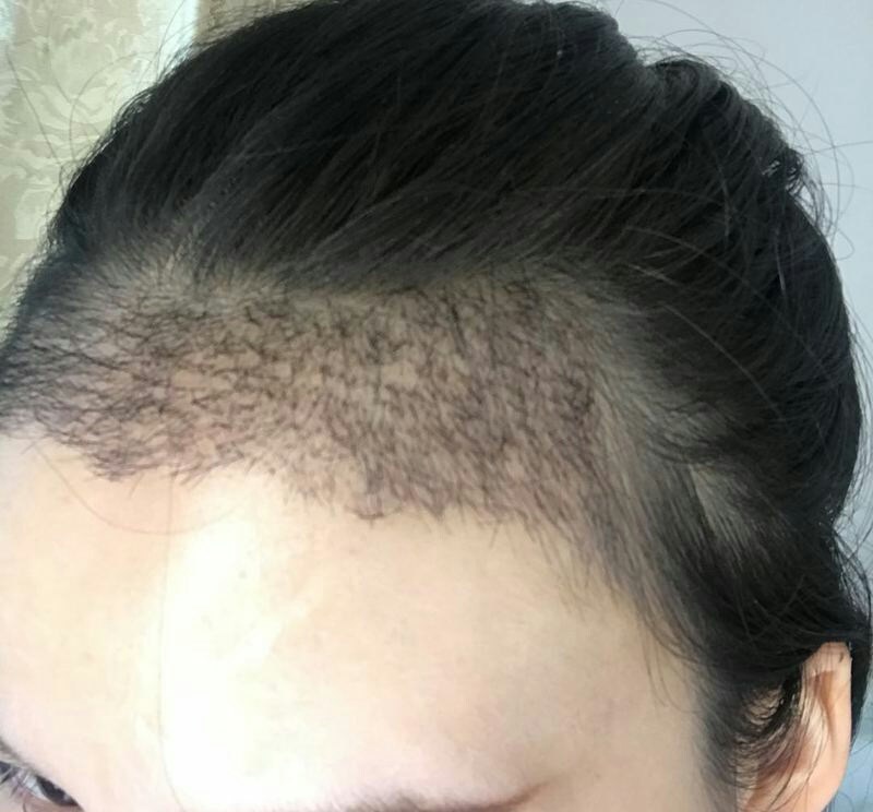 做完发际线快两个月了,在前段时间就慢慢的发现头发开始有脱落了,洗