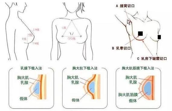 隆胸术
