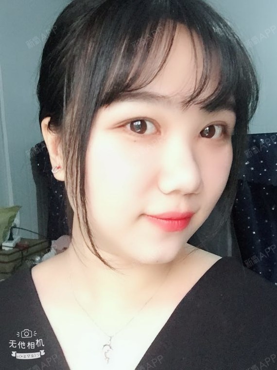 阿尔法的猫切开双眼皮第76天美丽日记-新氧美