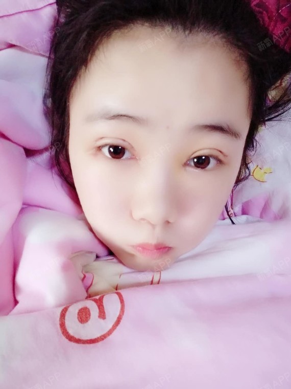 切开双眼皮
