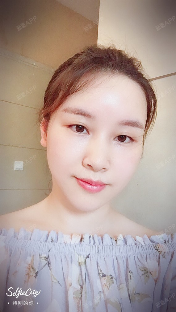 玫瑰椛开o自体脂肪全脸填充第45天美丽日记-新