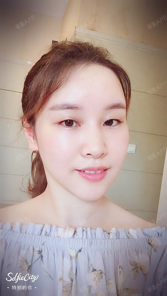 玫瑰椛开o自体脂肪全脸填充第45天美丽日记-新