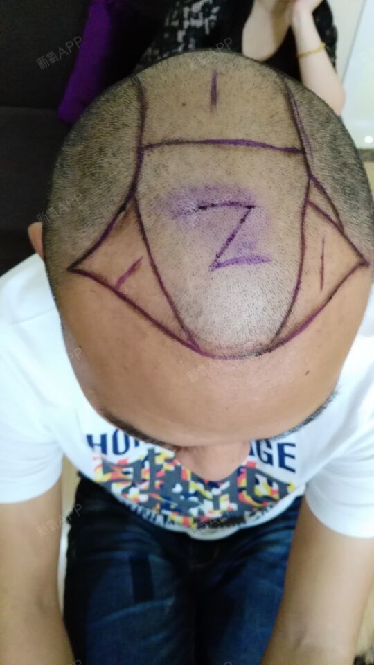 氧气xxhq2种植发际线第163天美丽日记-新氧美