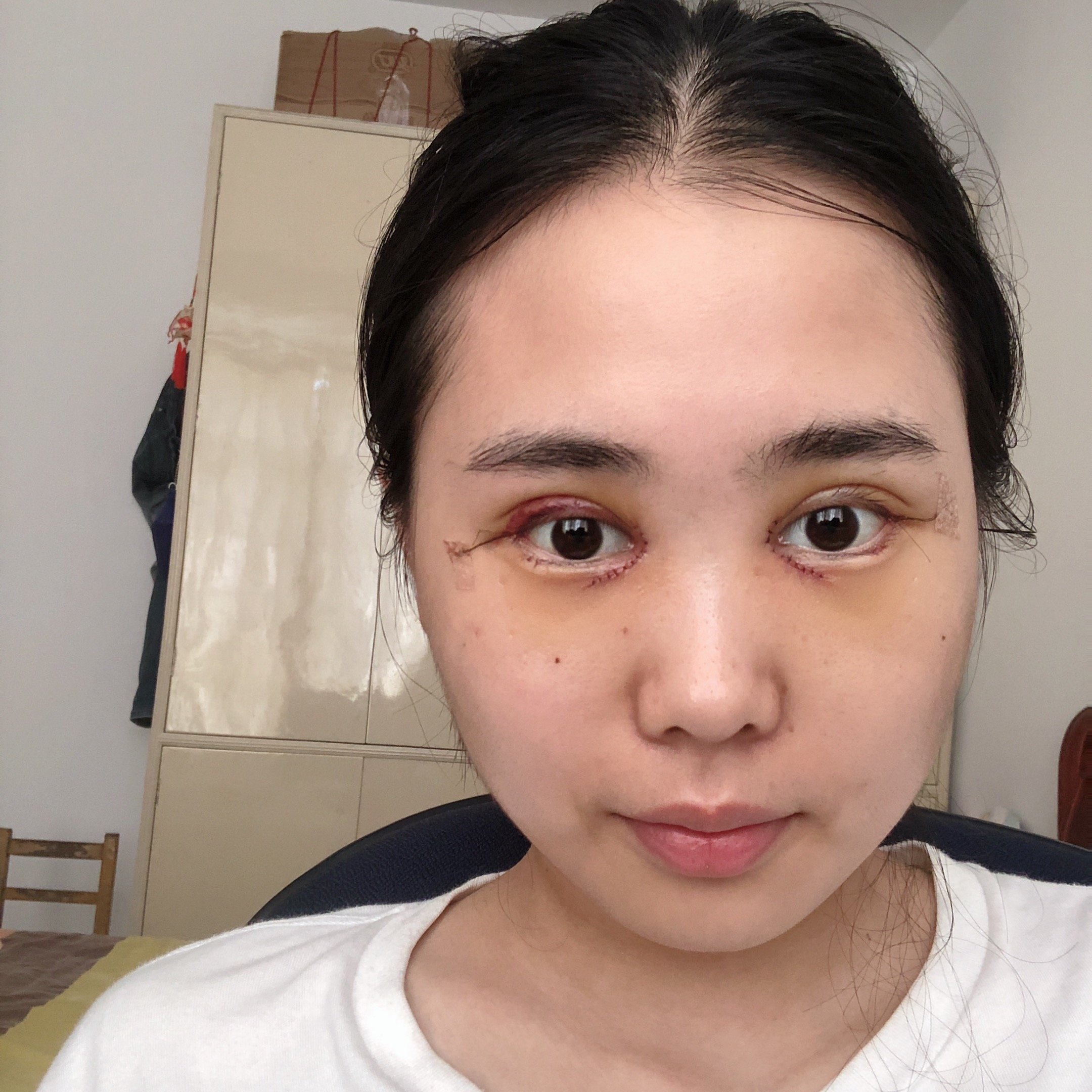 眼部综合怎么样_恢复过程_效果如何_氧气ni0a08c整形8
