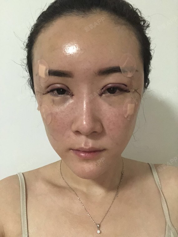 【青岛华颜美-自体脂肪面部填充第4天】