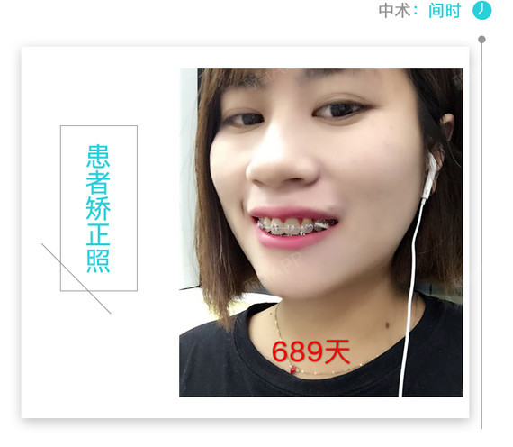 龅牙矫正案例
