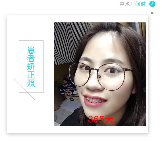 这2种情况是可以影响脸型的---暴牙与戽斗是牙弓与齿列不协调形成的