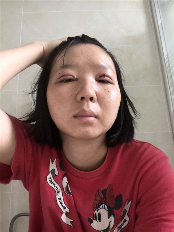 眼部综合怎么样_恢复过程_效果如何_回眸的瞬间整形5.