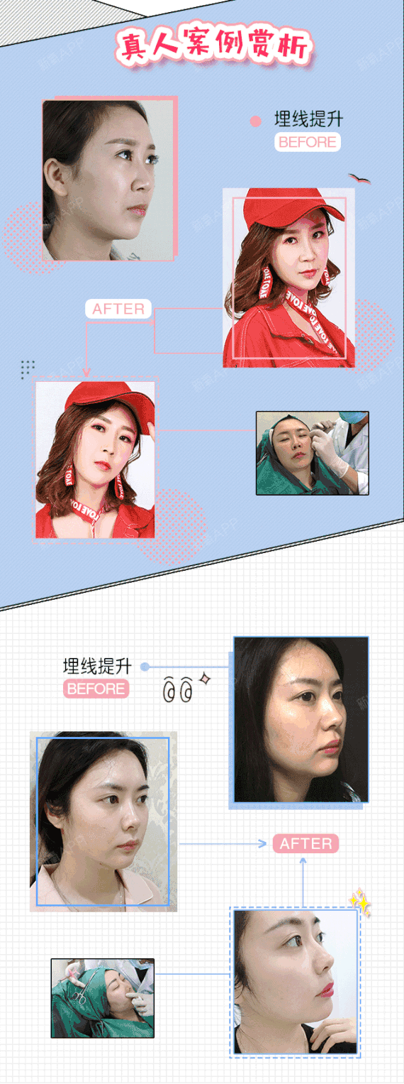 【埋线提升】①三维布线面部精雕②提升轮廓,改善脸型