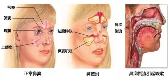 鼻炎指的是鼻腔粘膜和粘膜下组织的炎症,而隆鼻手术是在鼻骨上进行的
