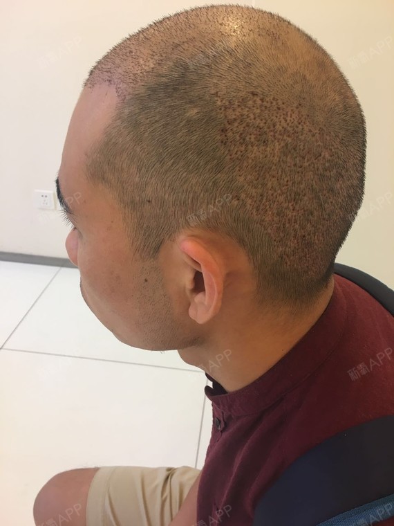 满心欢喜密探头顶加密种植第8天美丽日记-新氧