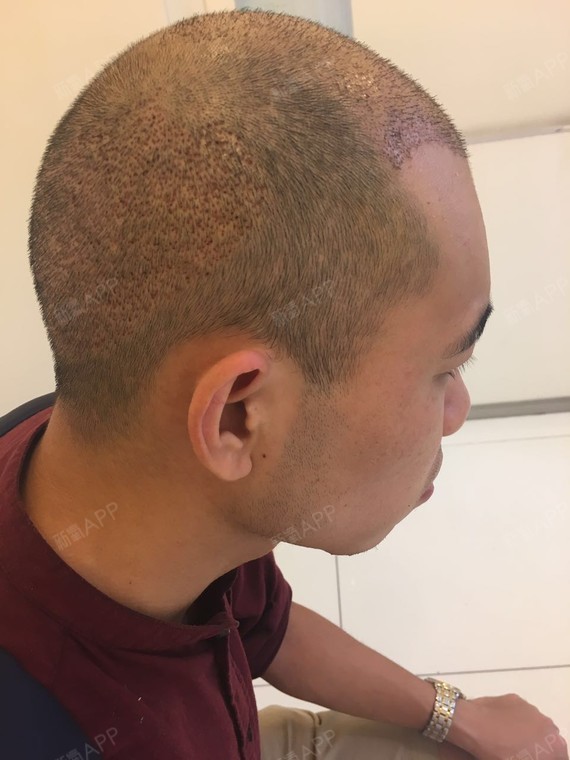 满心欢喜密探头顶加密种植第8天美丽日记-新氧