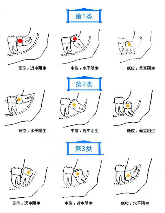 拔智齿的脸型变化图解_拔智齿的脸型变化图