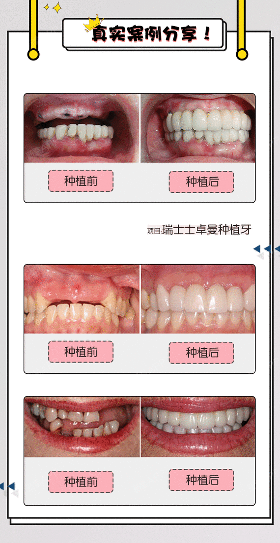 【种植牙】瑞士进口士卓曼种植体 稳固耐用 不伤临牙