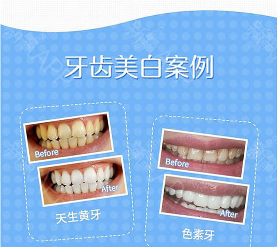 【冷光美白【医保定点】牙齿美白/皓齿美白告别色素
