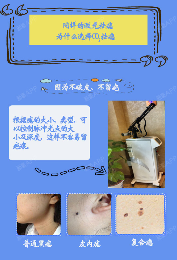 【激光点痣】强脉冲无痕祛痣/祛疣/去痦子/黑痣/色素痣/太田痣
