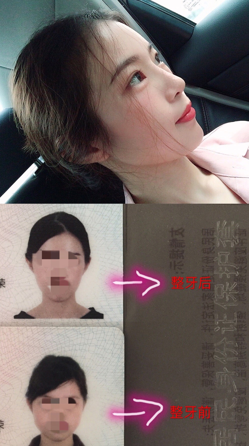 蛡5矫正牙齿期嘴巴和下半张脸变化 蛡5矫正完牙齿身份证上脸型变化 蛡
