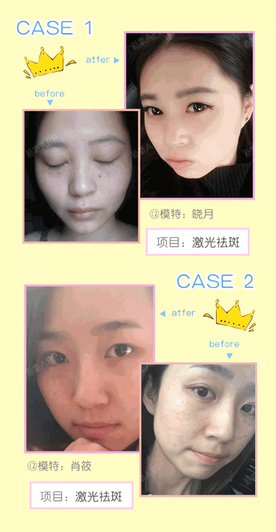 【激光祛斑】激光祛斑 调q激光三维透视瞬间爆破 祛雀斑/晒斑/痘印/红