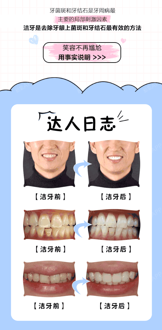 【超声波洗牙】360°深度清洁,给牙齿做一个spa,口