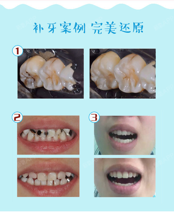 【补牙】单颗进口玻璃离子牙齿修复 告别牙齿缺陷