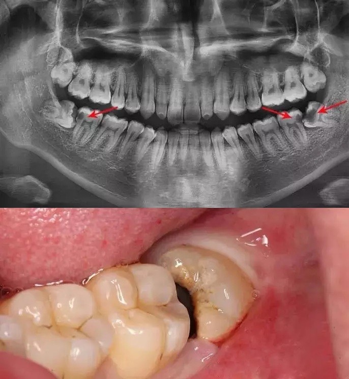 9793智齿,又叫第三磨牙,是生长在牙列最末端的