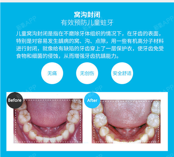 【补牙】【医保定点单位】乳牙/恒牙窝沟封闭2颗,高效