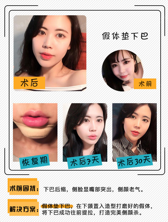 【硅胶垫下巴【下单赠韩式小气泡2次【包路费 减满红包 黄金