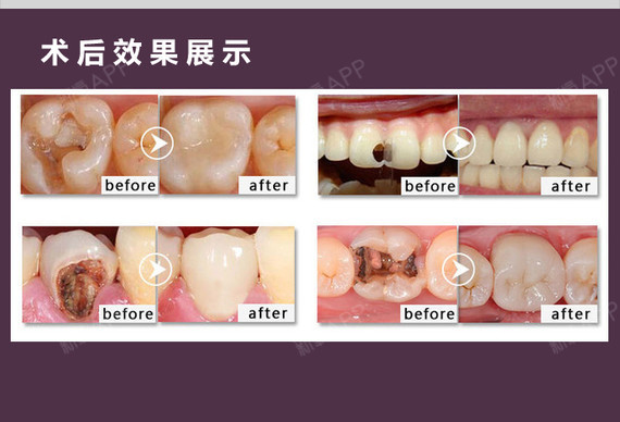 人钱蛋鸡是什么成语_钱人豪的电影_补牙多少钱