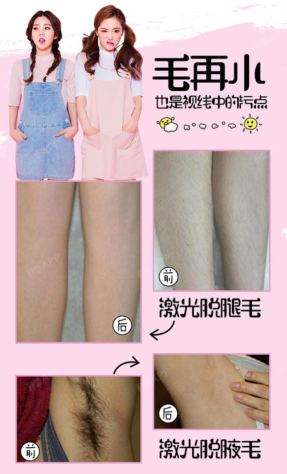 【激光脱毛】脱腋毛 5次 ,【超冰点无痛脱毛】放心脱光光,大胆露,做