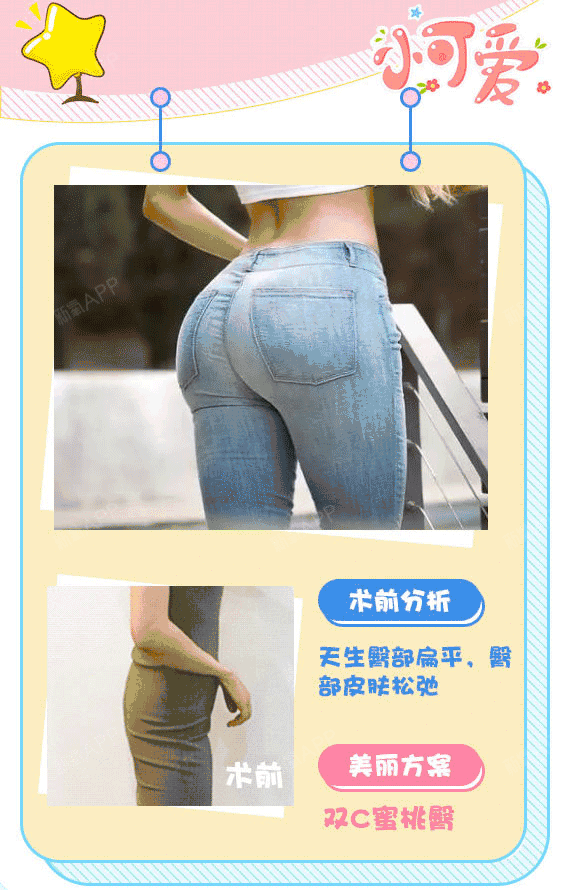 【自体脂肪丰臀】双c蜜桃臀 丰满诱人 打造性感股沟线 女人也要翘