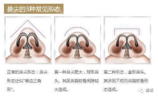 解决方法也很简单,就是把分开的两个鼻翼软骨拉拢缝合起来,让鼻尖变尖