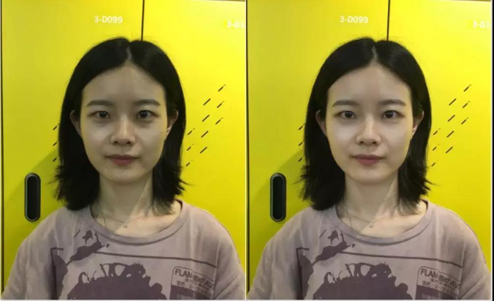 矫正偏颌版对比图.怀孕中打了瘦脸针吗图片