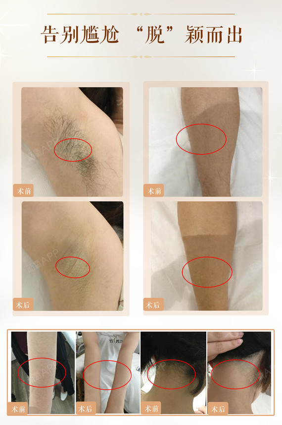 【激光脱毛】以色列进口比基尼线,前发际线,后发际线