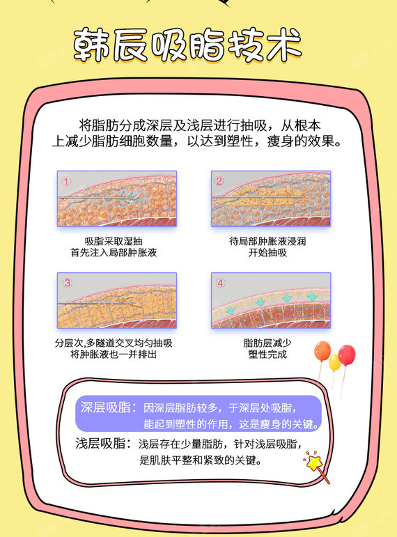 【吸脂】变美狂欢【水动力腰腹吸脂】水波动态腰腹环吸术 瘦身 塑形做