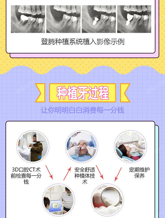 【种植牙】画美进口韩系种植体种一送一(冠) 稳固耐用