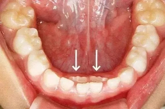 10个孩子里5个长双排牙,医生感叹:都是家长喂出来的