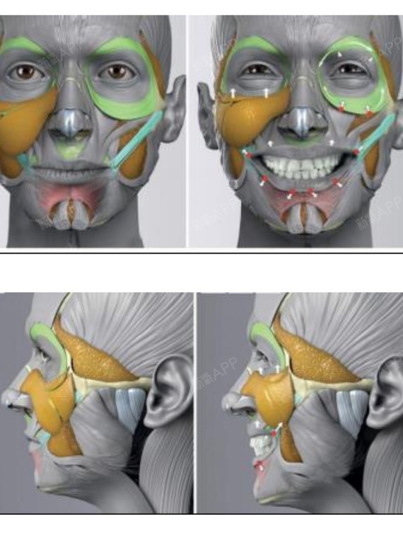 实际上从解剖学来看,面部脂肪并不是均匀的一整块,而是被韧带和筋