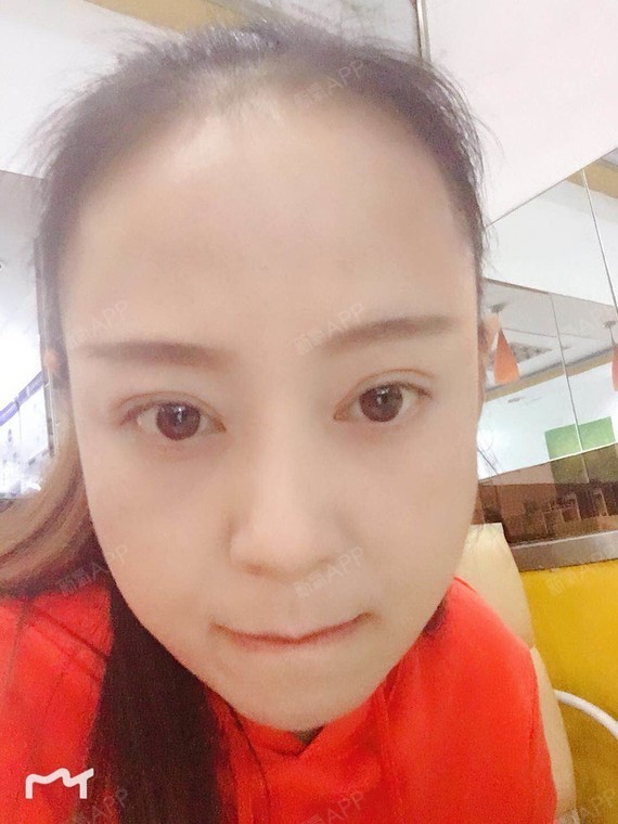 双眼皮修复术后一个月多点儿,像第一次做双眼皮一样,增生也如期而至