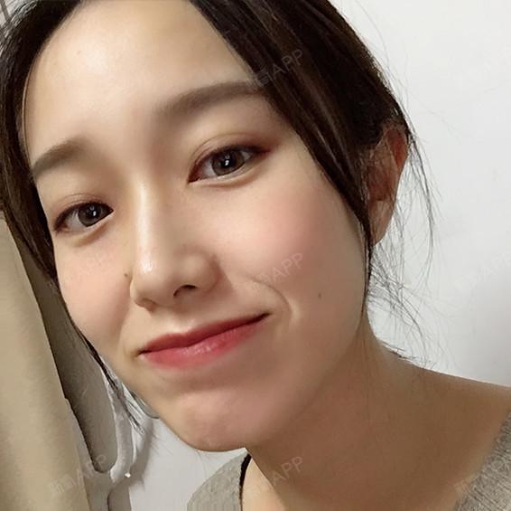 氧气aing自体脂肪全脸填充第10天美丽日记-新