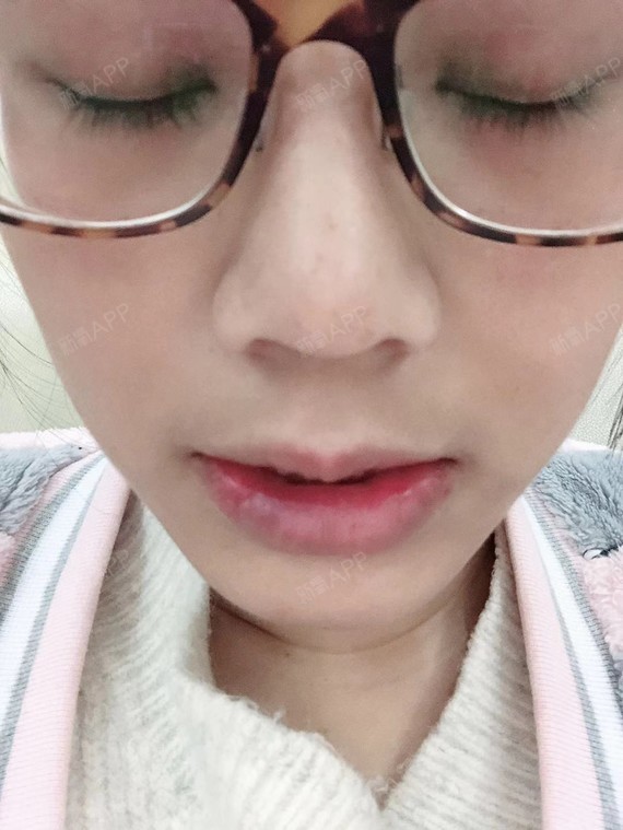 长沙厚唇改薄好不好_效果图_氧气y6x46厚唇改薄术后第
