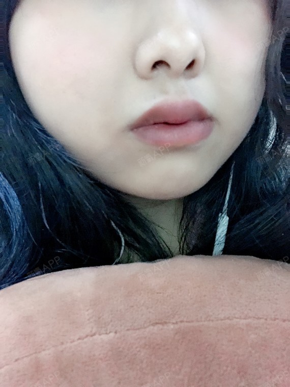 有完全的消肿,昨天拆线的时候有一点点疼痛,因为在唇部所以看不出疤痕
