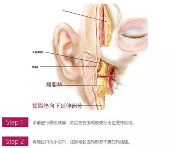 颊脂垫瘦脸术