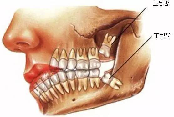 智齿阴生,萌出不全会引起局部肿胀疼痛  罪行三 智齿位置不正,造成