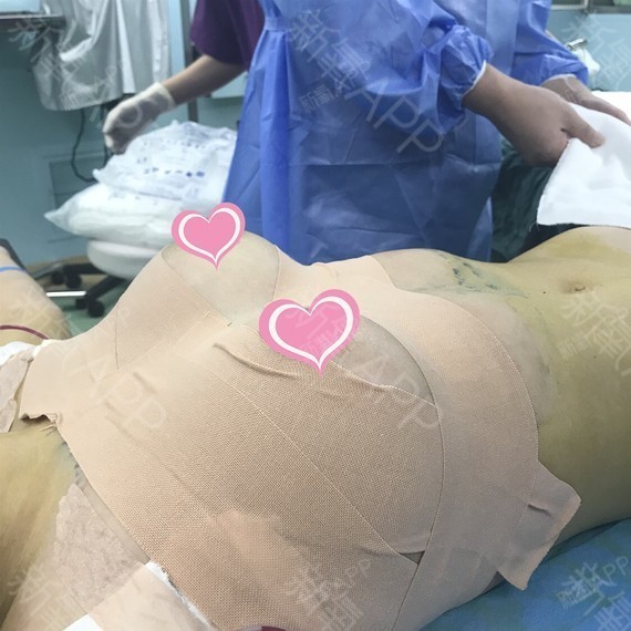 假体隆胸