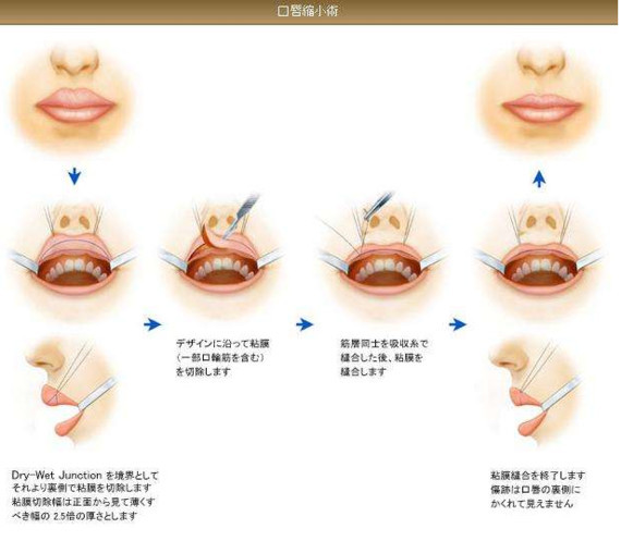 厚唇/重唇修薄整形手术手术目的与效果:修薄红唇