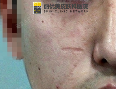 像这样比较凹陷的疤痕不只是治疗皮肤表皮层那么简单,单纯利用飞梭机