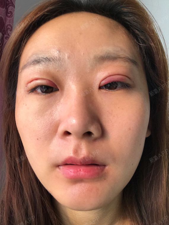 我觉得形状我很喜欢呢,下定决心 一定要做了,刚做完第一天,因为双眼皮